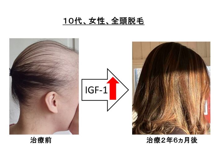 円形脱毛症　病院